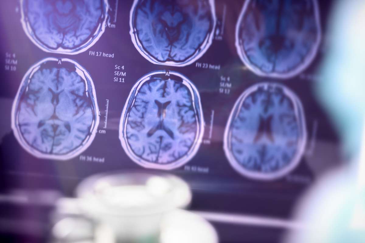 Alzheimer: scoperta incredibile